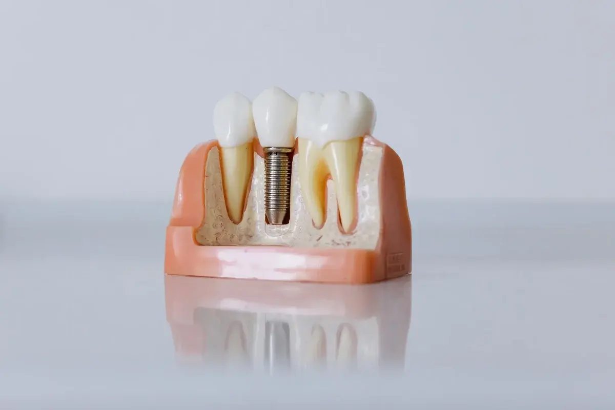 A dental implant model displaying teeth and an implanted screw.